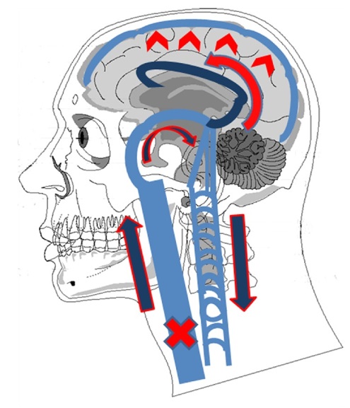 sinuses of head diagram. Another diagram of quot;abnormalquot;